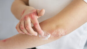 Tratamento psoríase dermatologista rio de janeiro 